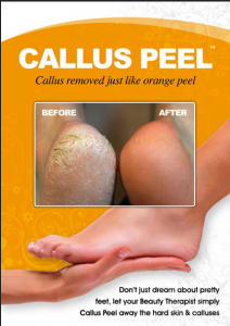 callus peel